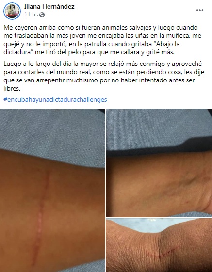 Iliana Hernández muestra las agresiones en su cuerpo tras ser detenida por la Seguridad del Estado