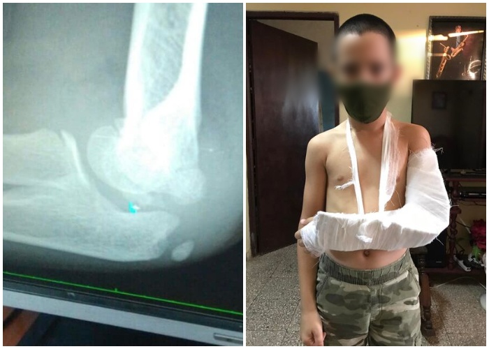 Padre denuncia falta de yeso para su hijo en hospital de Holguín