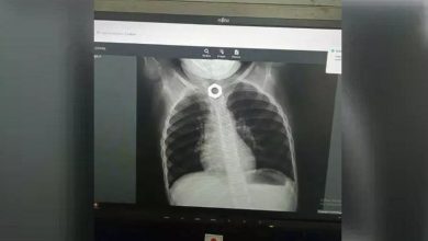 Doctores extraen tuerca de la garganta de una niña en Holguín