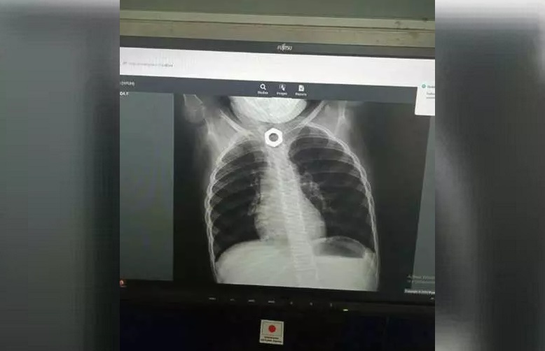 Doctores extraen tuerca de la garganta de una niña en Holguín