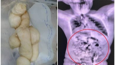 El hombre tenía casi 50 cápsulas dentro de su cuerpo. (Foto © vicejefeagr-Twitter)