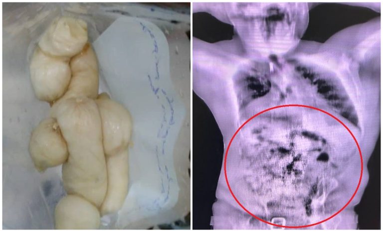 Pasajero intentó entrar a Cuba con cápsulas de droga ocultas en su cuerpo